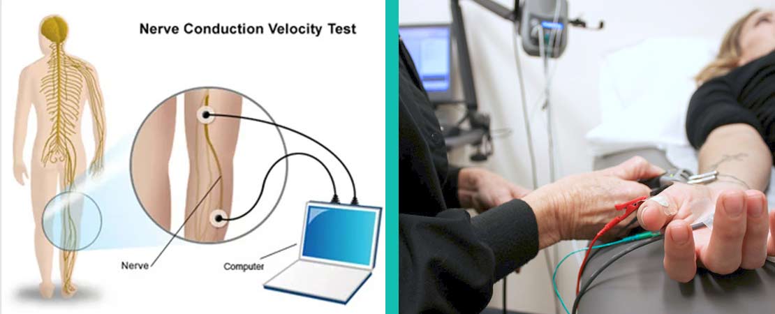 Nerve Conduction Velocity (NCV) test in Delhi