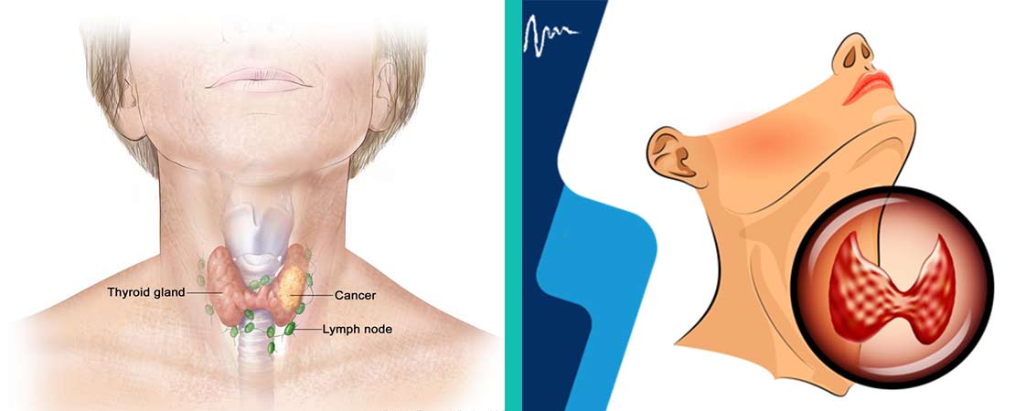 TFT (Thyroid) test in Delhi